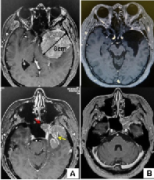 蝶骨嵴脑膜瘤严重吗？内镜下经蝶窦入路切除蝶骨嵴脑膜瘤案例一则