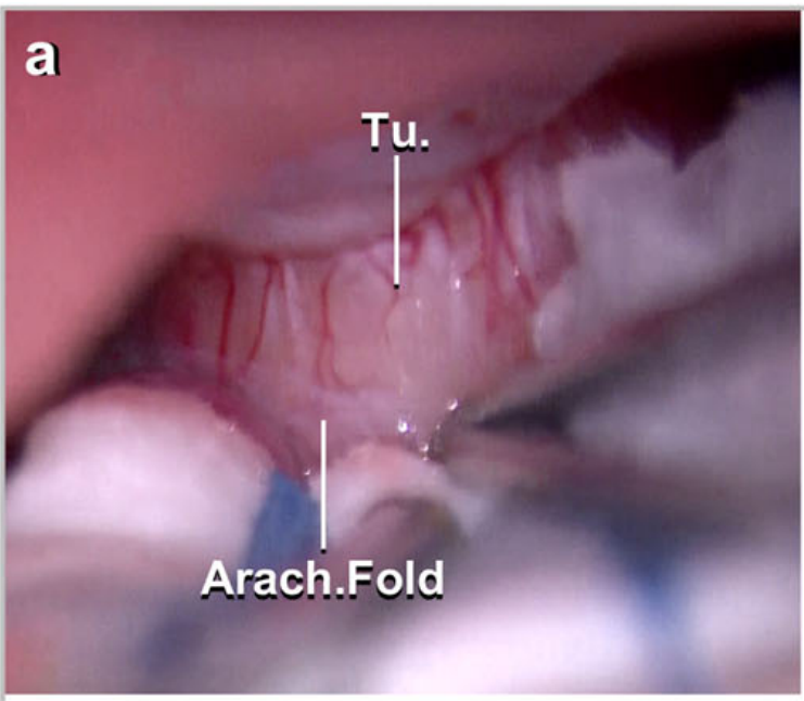 不面瘫保留听力：经乙状窦后入路切除听神经瘤