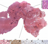 多形性胶质母细胞瘤激光间质热疗（LITT）的组织学发现