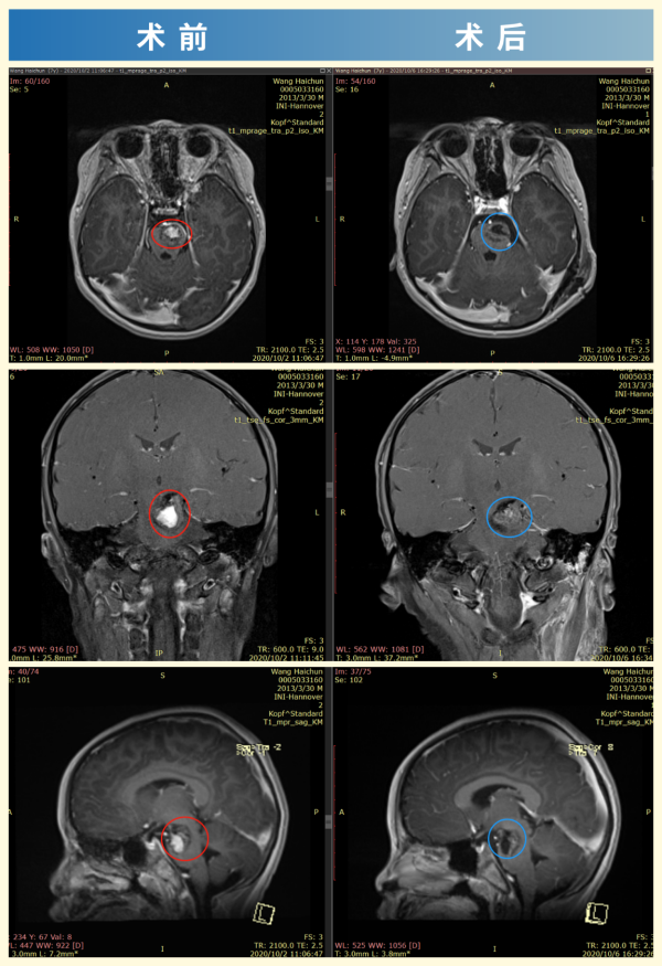 脑血管瘤案例图片