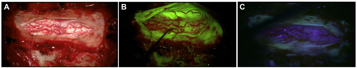 脊髓肿瘤手术案例