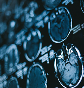 胶质母细胞瘤病因有哪些？