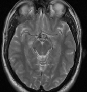 视交叉脑海绵状血管瘤的外科治疗