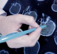 脊索瘤分子靶向治疗的系统评价