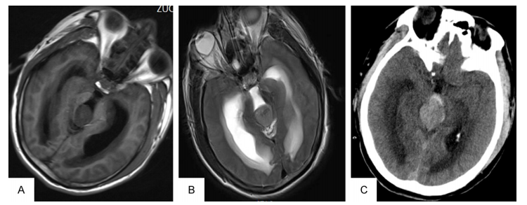 脑脊液分流治疗松果体肿瘤