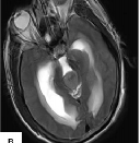 脑脊液分流治疗松果体肿瘤，手术后会出现哪些并发症？