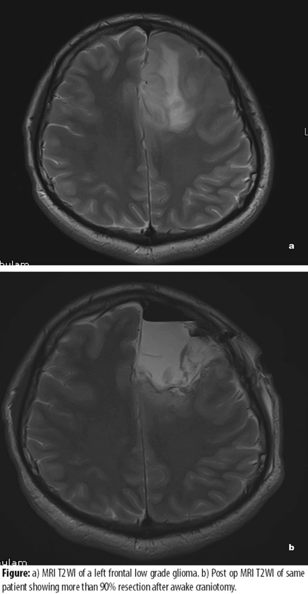 低级别神经胶的南瘤