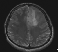 神经胶质瘤预后怎么样？低级别胶质瘤会恶化成癌症吗？