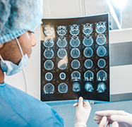 脑胶质瘤生存期有多久？恶性脑肿瘤术后8年没有复发实例