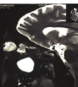 视神经胶质瘤未积较治疗，恶化竟导致失明