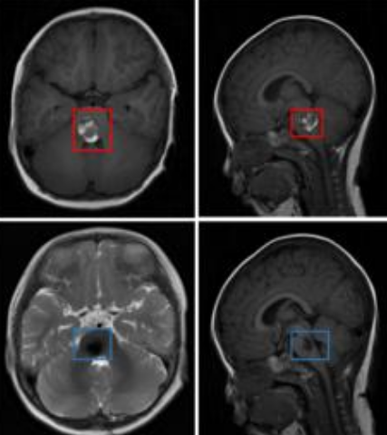 <a href='/bingzhong/xueguanliu/' target='_blank'><u>脑海绵状血管瘤</u></a>