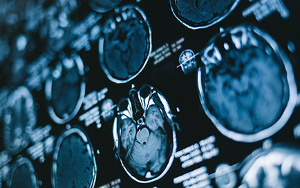 脑胶质瘤晚期较长能活多久？