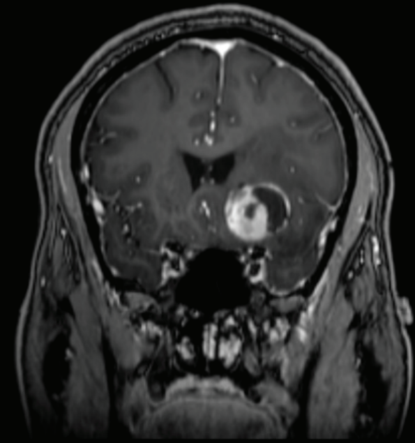 脑部胶质瘤如何治疗？简述多形性黄体星形细胞瘤
