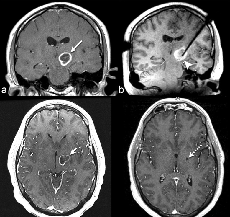 脑瘤治疗新技术：激光消融术脑瘤