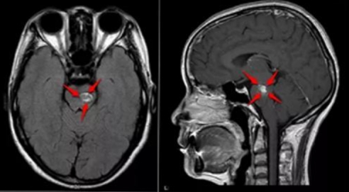 脑干海绵状血管瘤