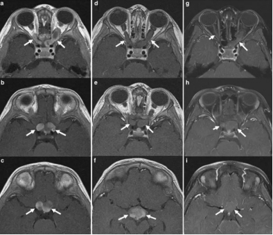 视神经胶质瘤能做手术吗?会导致失明吗?
