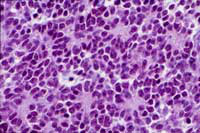 髓母细胞瘤