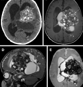 较大的脑室海绵状血管瘤案例报告一则