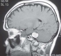 听神经瘤造成颞下颌关节紊乱病案例一则