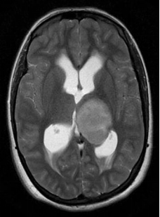 丘脑胶质瘤的放射学特征