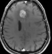 深度解析胶质母细胞瘤新疗法进展