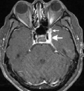 海绵窦疾病的诊断