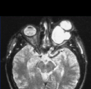 儿童视神经胶质瘤