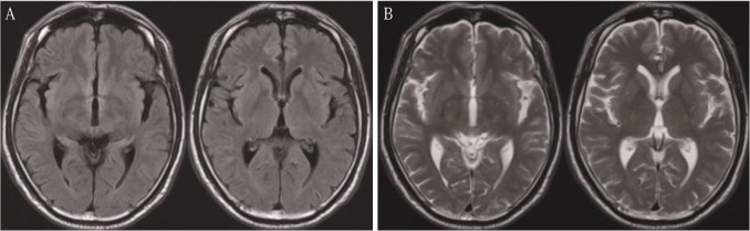 <a href='/bingzhong/sgtqzl/' target='_blank'><u>松果体区肿瘤</u></a>