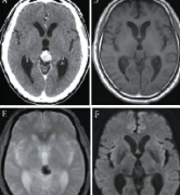 松果体区生殖细胞肿瘤好治吗？内镜联合治疗案例报告一则