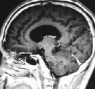 听神经瘤能自愈吗？