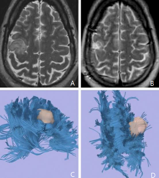 右侧中央小叶胶质瘤