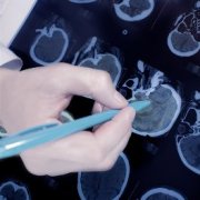 听神经瘤怎么治疗比较好？