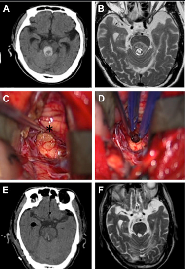 脑干海绵状血管瘤如何治疗