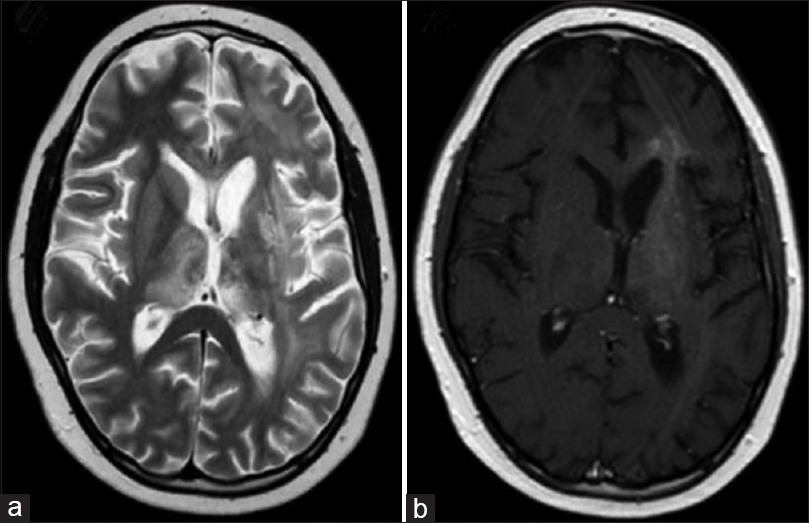 10岁儿童神经<a href='/jibing/naojiaozhiliu/1548.html' target='_blank'><u>胶质瘤治疗</u></a>案例