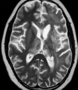 神经胶质瘤是什么症状？警惕这名10岁男孩的悲剧