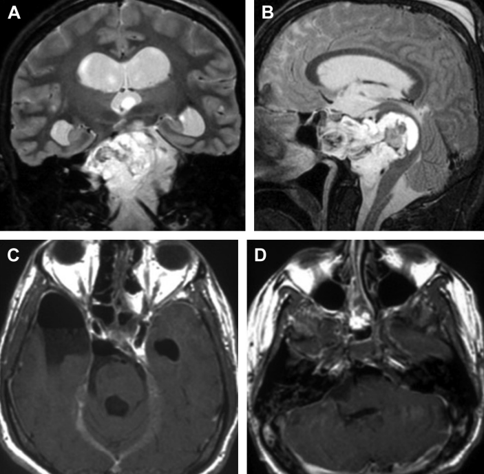 脊索瘤手术切除后是否需要质子治疗？