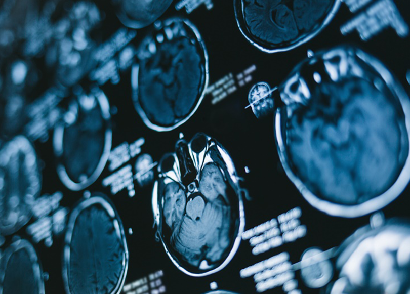 大脑凸面脑膜瘤手术