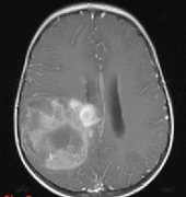 脑部胶质瘤有什么症状？小儿脑胶质瘤的治疗希望在哪？