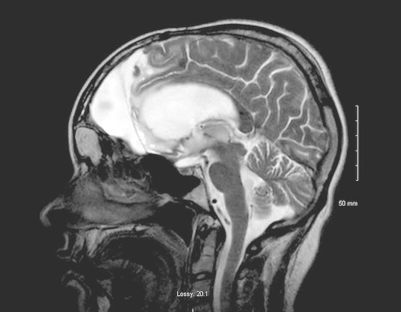 儿童颅底脑膜瘤综述：不同位置如何选择手术入路？