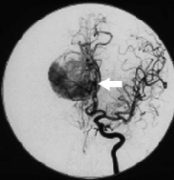 高度血管性脑膜瘤手术难度大吗？大型镰旁脑膜瘤手术案例一则
