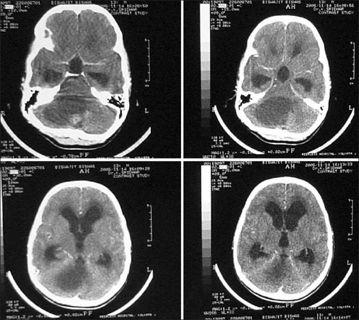 神经胶质瘤早期症状是什么？儿童脑胶质瘤哪些专家治得好？