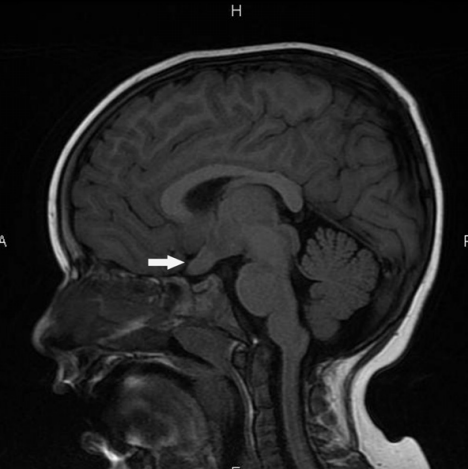 神经纤维瘤是什么病？