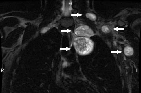 神经纤维瘤手术切除