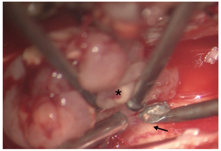 毛细胞星形细胞瘤手术治疗