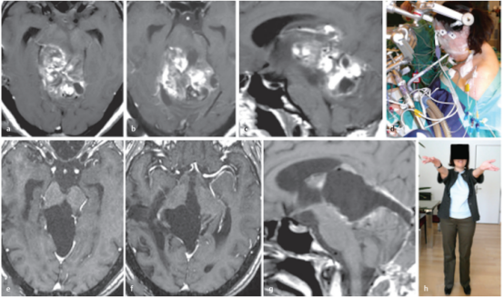 成人脑干胶质瘤