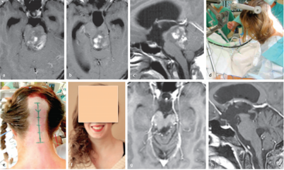 脑毛细胞星形细胞瘤全切