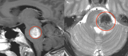脑干肿瘤案例