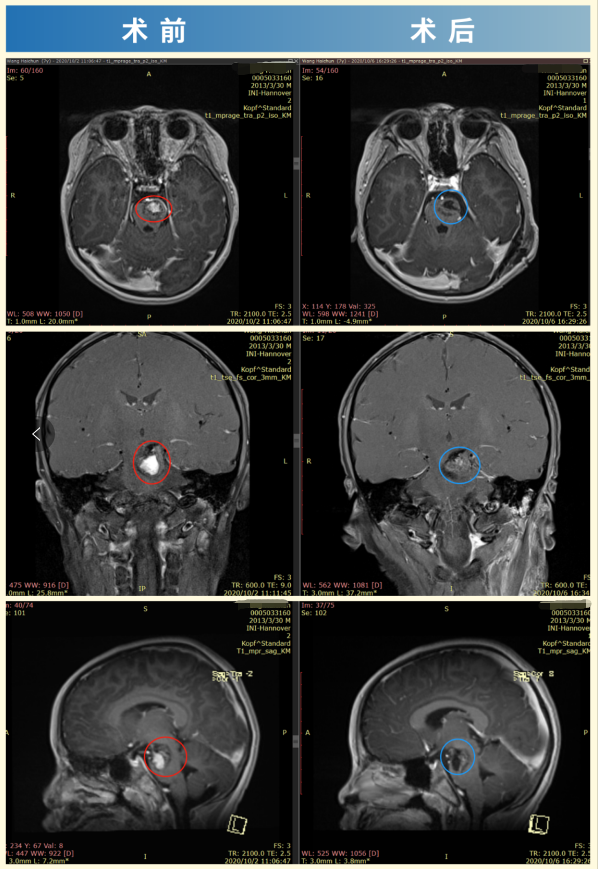 脑干海绵状血管瘤手术案例对比