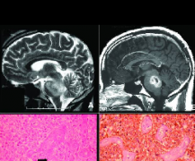 成人脑干胶质瘤可以手术吗？