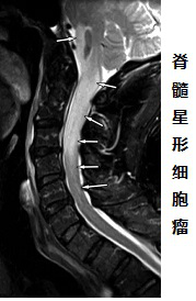 脊髓胶质瘤诊断